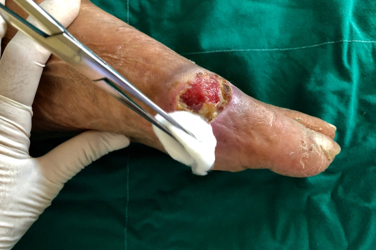 Orthopedic Treatment for Infected Diabetic Foot Wounds A Comprehensive Guide