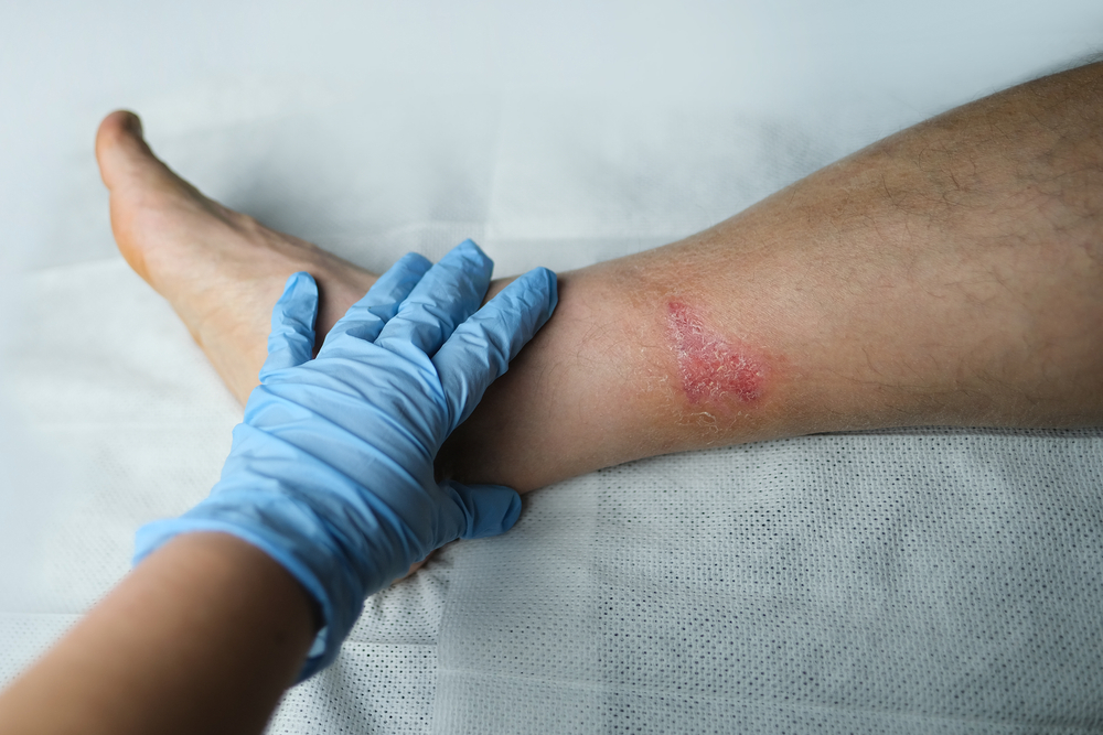 Doctor for Infected Wounds What You Need to Know