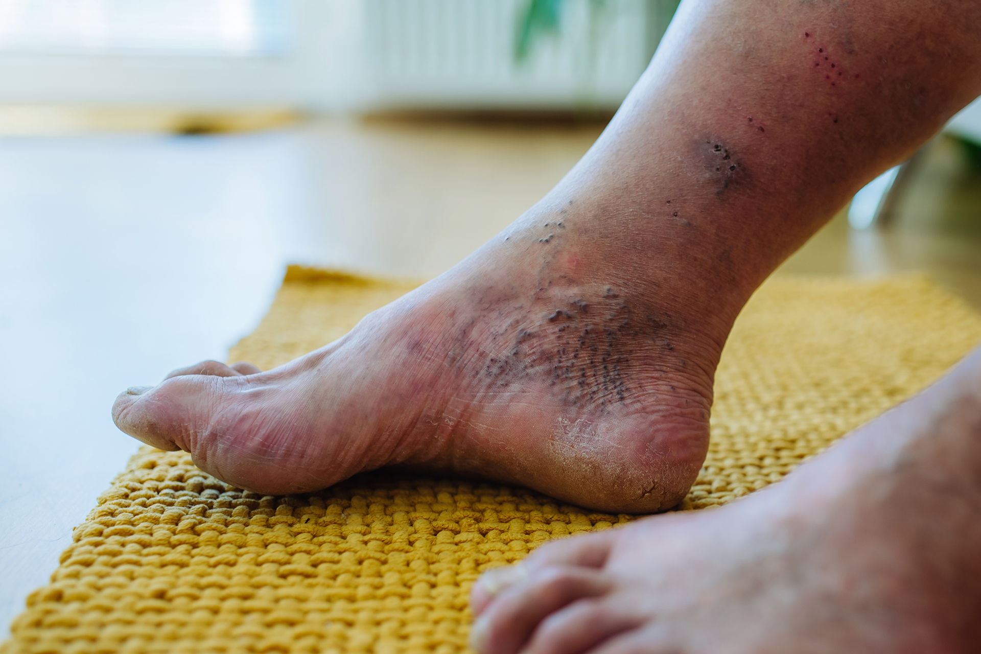 Comprehensive Diabetic Foot Ulcer Management Strategies for Optimal Healing and Prevention