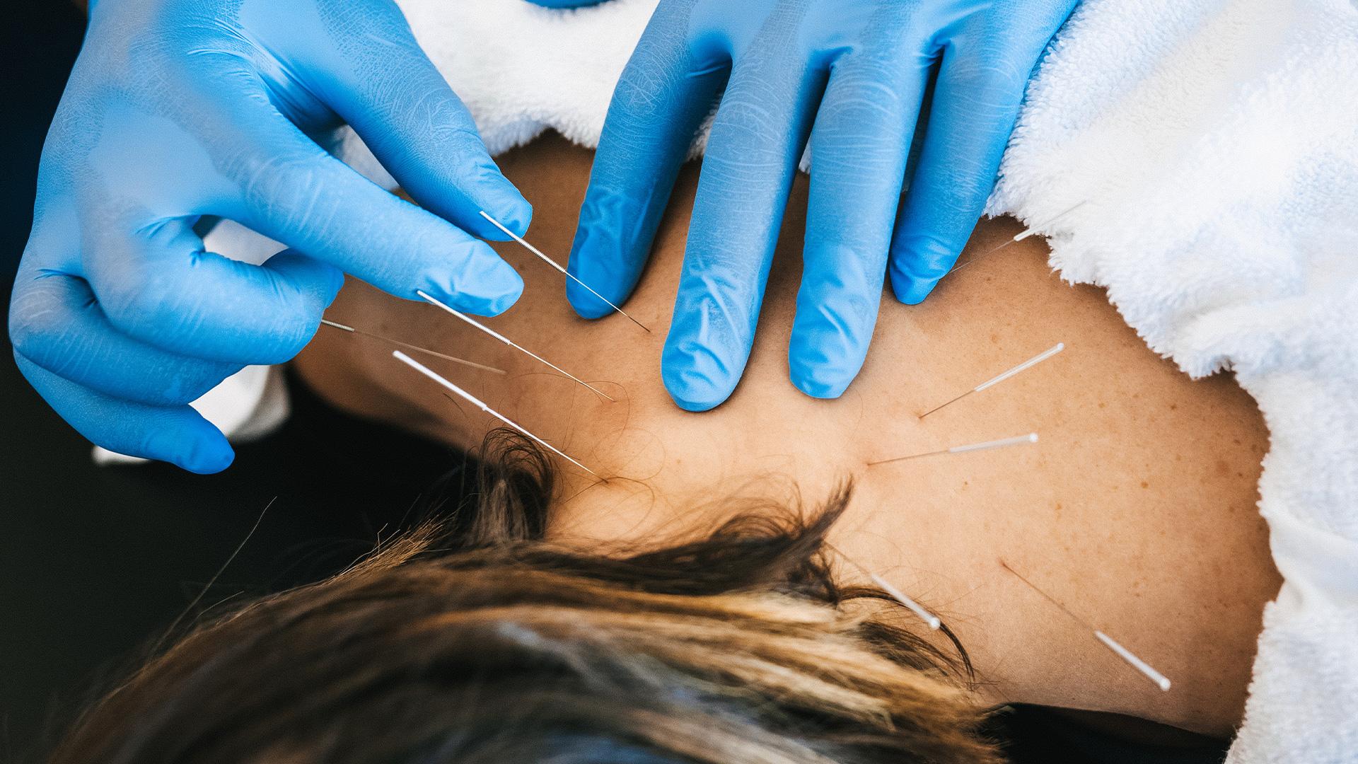 Discover the Benefits of Dry Needling Treatment in Fishers for Pain Relief and Mobility
