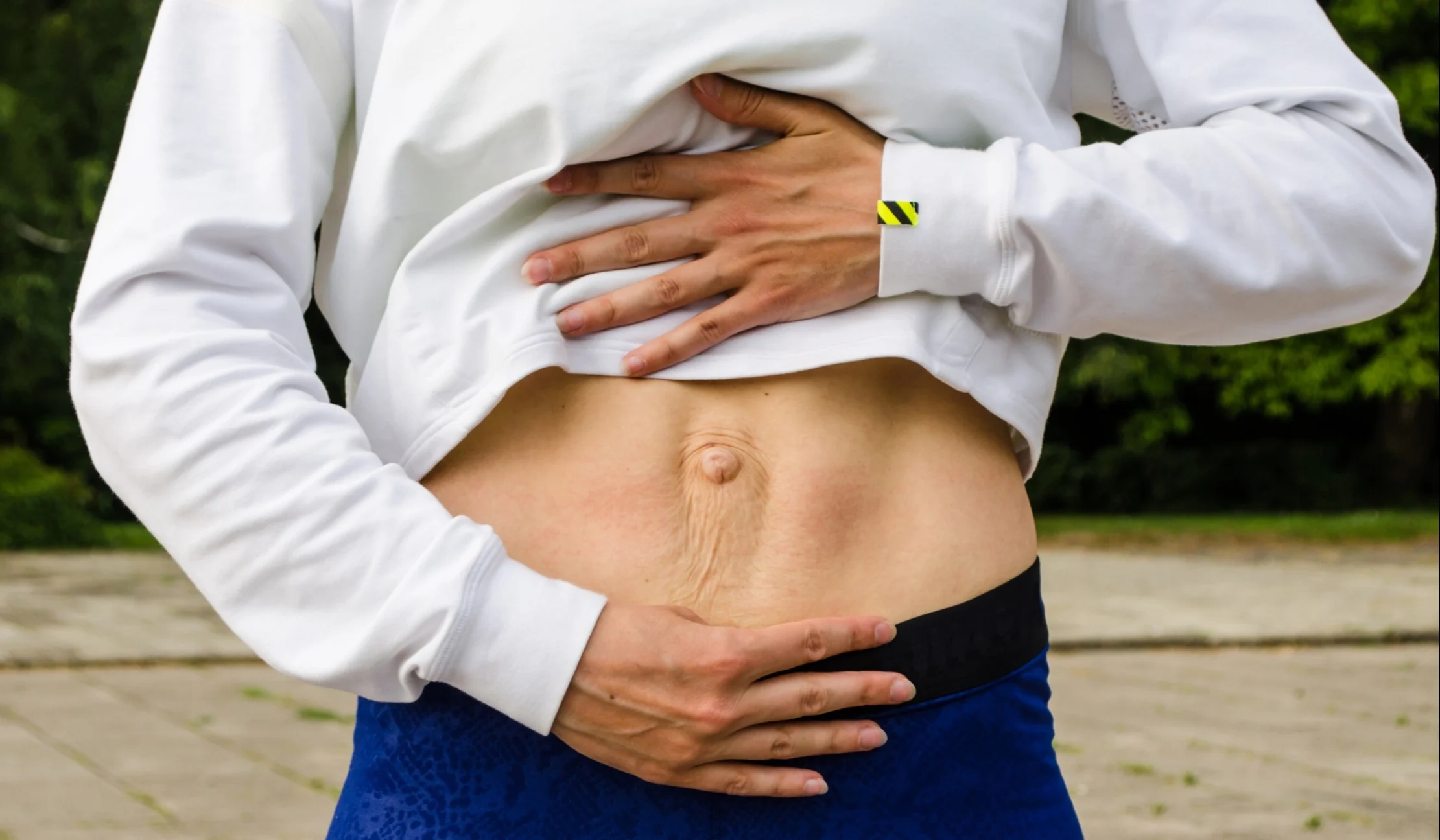 Treatment for Diastasis Recti Fishers A Comprehensive Guide