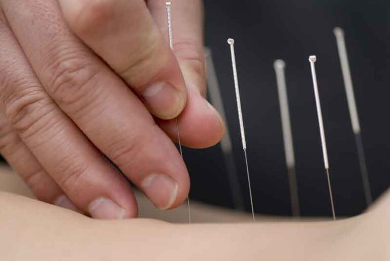 Experience the Healing Power of Dry Needling Treatment in Fishers A Modern Solution for Muscle Pain and Recovery